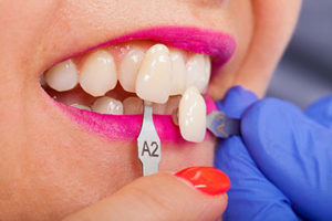 A dentist checks dental veneers in TX against a woman's teeth