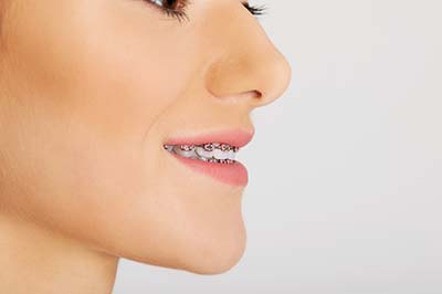 overbite correction young woman needing overbite correction