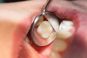 close up of dental exam for dental fillings and sealants in Bellaire, TX