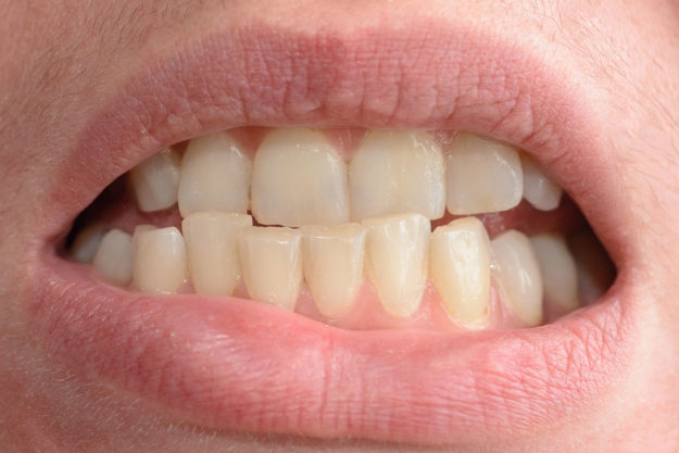 how to prevent teeth shifting (2) crooked teeth due to causes of teeth shifting
