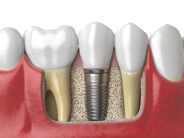 a model of a endosteal implants