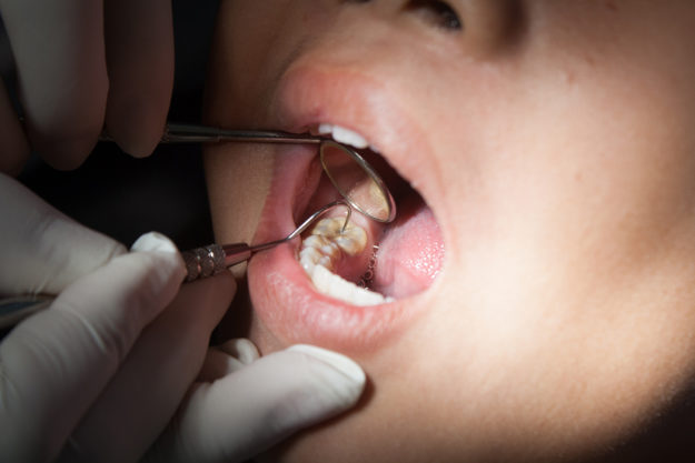 a person getting dental sealants for the first time