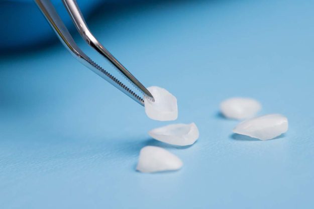 applying dental veneers