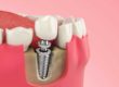 example of single tooth implant