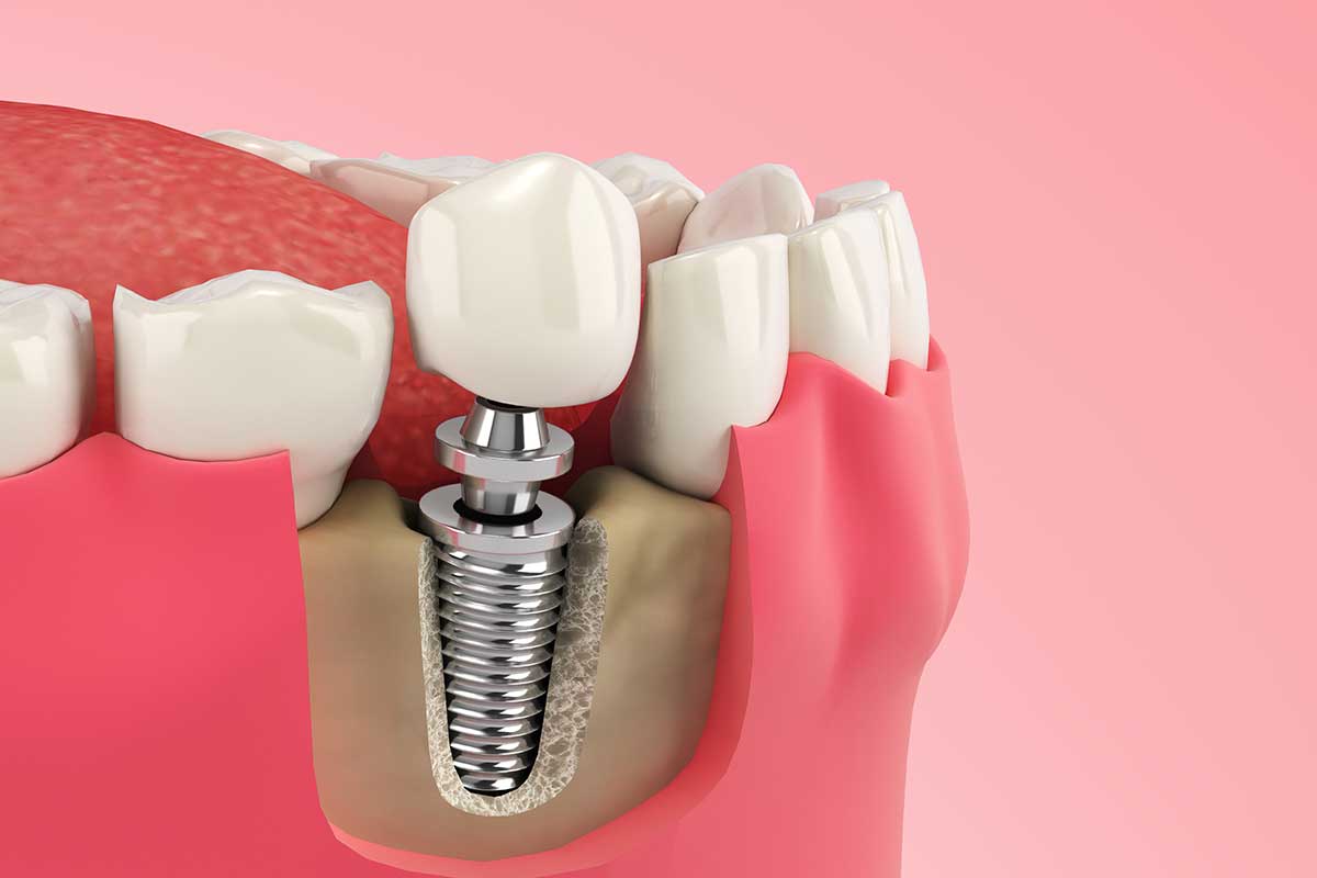 example of single tooth implant