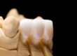 benefits of dental veneers bellaire texas