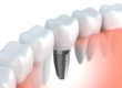 how to dental implants work