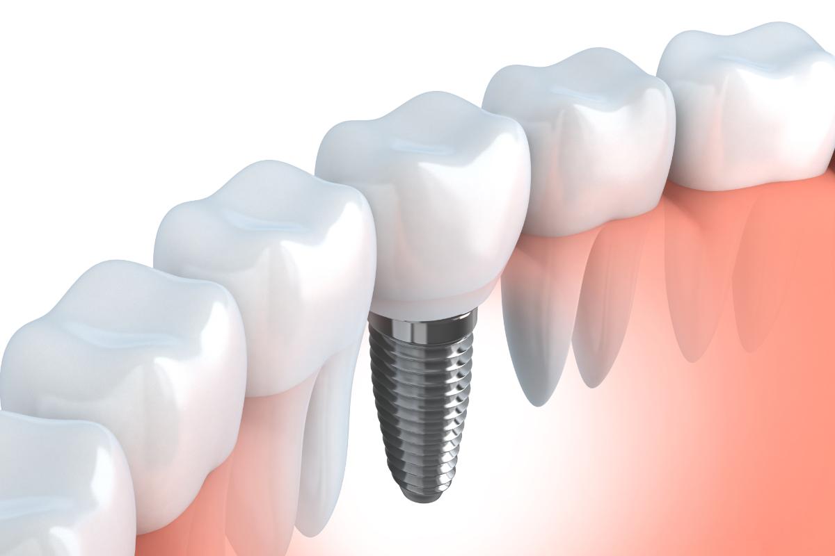how to dental implants work